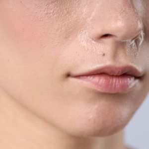 Close-up of dry skin and dehydrated skin showing texture and dryness